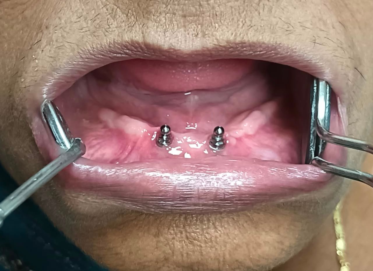 Patient 2 Ball Abutment Base Before Treatment